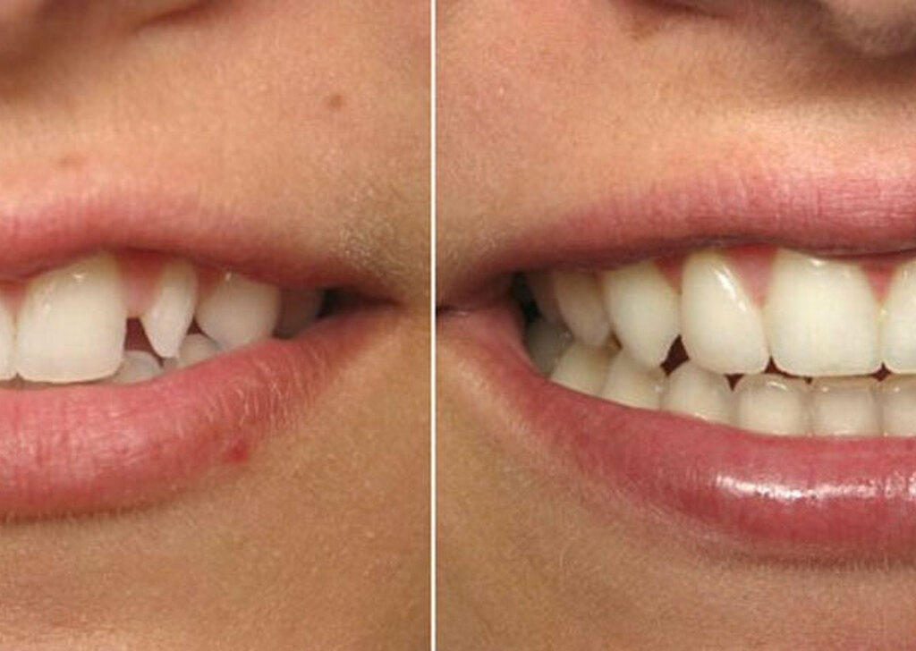 Реставрация фотополимером. Наращивание Зов. Восстановление передних зубов. Наращивание зубов до и после.